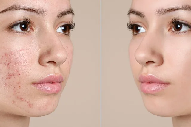 Newport Beach Skin Glo Package with Microderm and LED - Image 6
